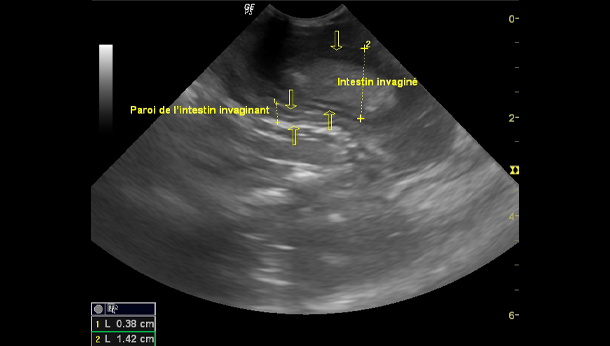 Echographie abdominale